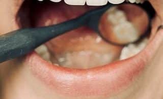 Managing Pain and Swelling After Tooth Removal