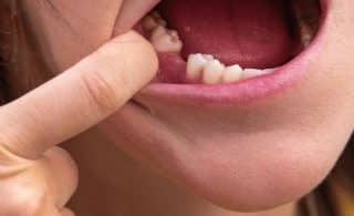 Tooth Extraction Recovery Timeline