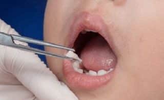What to Expect After a Tooth Extraction?