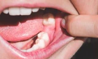 Gum Healing After Tooth Extraction