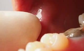 When Tooth Extraction Is the Right Treatment Option?