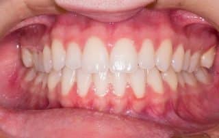 Early Signs of Gum Disease