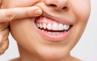 Long-Term Effects of Untreated Gum Disease