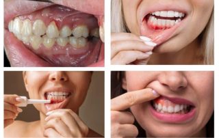 Treating Gum Disease in Its Early Stages