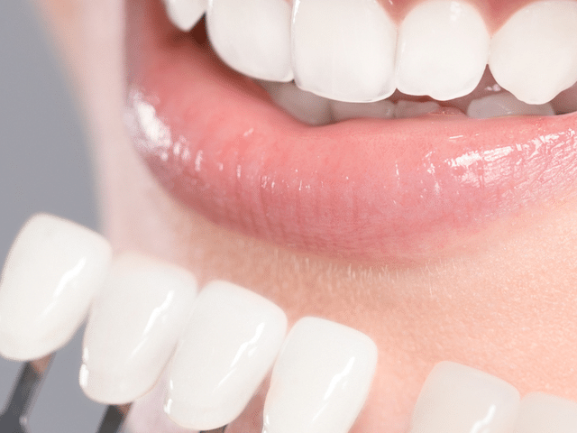How Long Teeth Whitening Results Last
