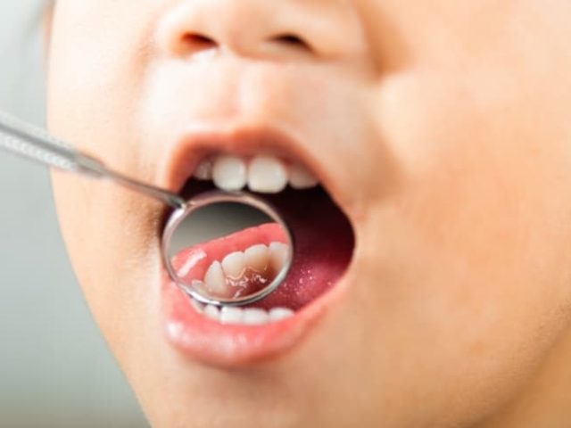 Preventing Cavities in Children