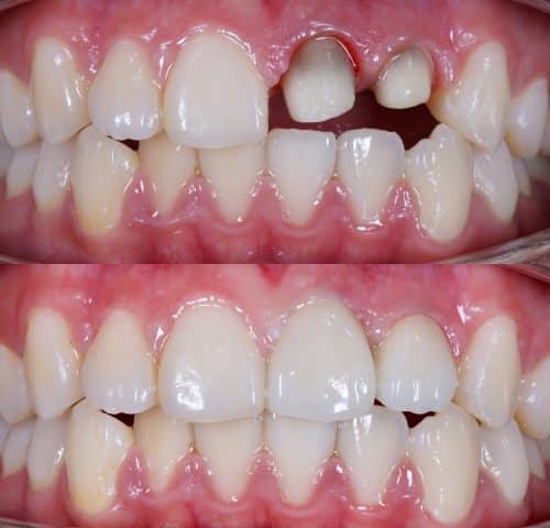 Dental Crown Procedure Overview