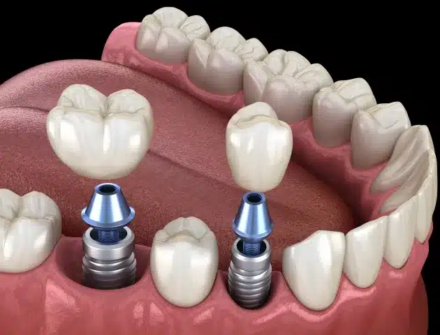 How Long Dental Crowns Typically Last