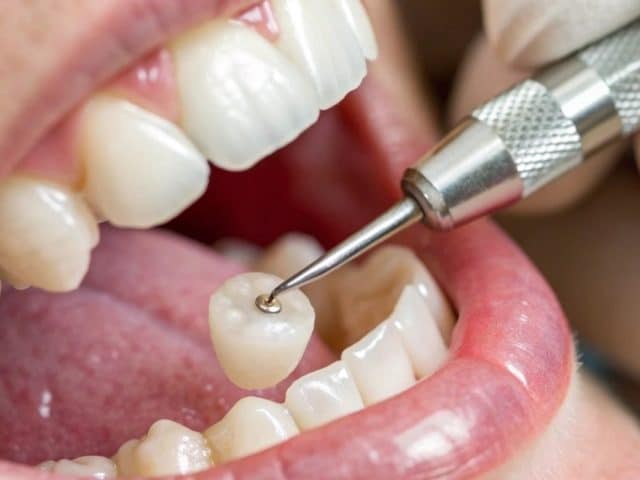 Signs You May Need a Dental Crown